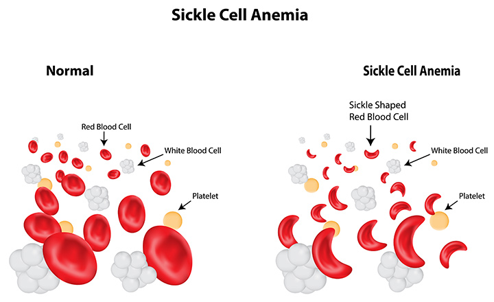 what-you-should-know-about-sickle-cell-disease-odisha-watch